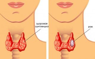 Онкомаркеры щитовидной железы: какие сдавать, норма, расшифровка результатов