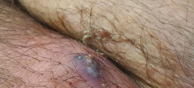 Лимфоузлы в паху: где находятся, причины воспаления, увеличения и боли