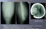 Саркома юинга: симптомы, фото, прогноз выживаемости и лечение