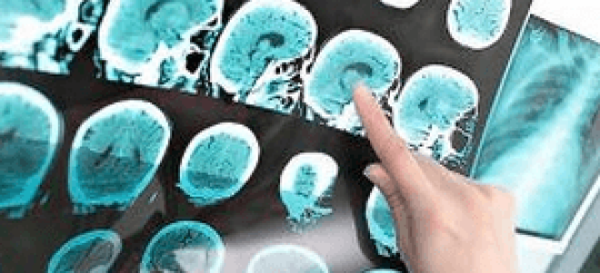 Гигрома головного мозга: виды, лечение, симптомы и причины