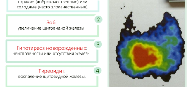 Сцинтиграфия щитовидной железы: как проходит исследование, подготовка, противопоказания и результаты