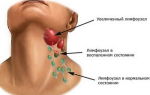 Воспаление лимфоузлов на шее: лечение, причины, симптомами каких заболеваний является, фото