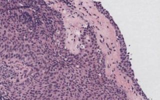 Уротелиальная карцинома мочевого пузыря: виды, симптомы и прогноз