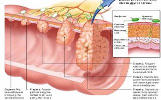 Рак кишечника 4 стадии: сколько живут с метастазами, прогноз выживаемости после операции