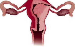 Рак тела матки: стадии, причины, симптомы, лечение и диагностика