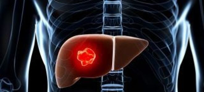 Аденома печени: симптомы, лечение, диагностика