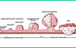 Опухоль желудка: симптомы, классификация, признаки на ранней стадии