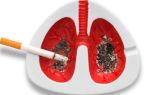 Рак лёгких: симптомы на ранних стадиях, причины, лечение, виды и прогноз