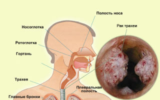 Рак трахеи: причины, симптомы, стадии, лечение и диагностика