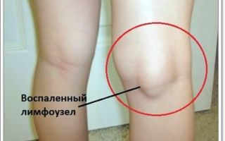 Лимфоузлы на ногах: расположение, фото, причины воспаления и лечение