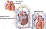 Рак сердца: симптомы, причины, стадии и продолжительность жизни