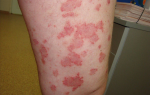 Лимфома кожи: фото, симптомы и лечение