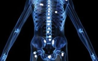 Метастазы в костях: симптомы, лечение, прогноз срока жизни