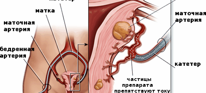 Кровотечение при миоме матки: как остановить, причины и лечение