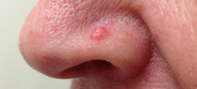 Базальноклеточный рак кожи на начальной стадии: фото, симптомы и лечение