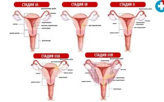 Аденокарцинома матки: прогноз, симптомы, стадии, операция и лечение