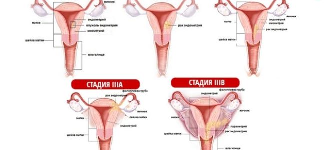 Аденокарцинома матки: прогноз, симптомы, стадии, операция и лечение