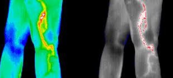 Термография: назначение, как проводится при диагностике заболеваний молочных желёз и яичек