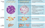 Аденокарцинома толстой кишки: формы, прогноз, симптомы и лечение