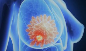 Сколько живут с раком груди: прогноз выживаемости при раке молочной железы