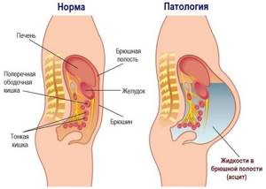 Фиброма яичника: чем опасна, симптомы, лечение и необходимость операции