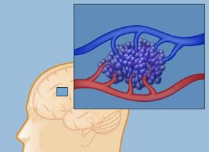 Гемангиома головного мозга: лечение, виды, симптомы и прогноз