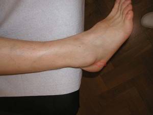 Гигрома на ноге: лечение, фото, симптомы, чем опасна
