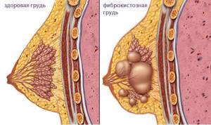 Диффузная фиброзная мастопатия: лечение, признаки и диагностика