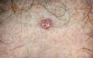 Саркома кожи: фото начальной стадии, симптомы и прогноз