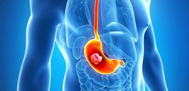 Перстневидноклеточный рак желудка: прогноз, стадии и симптомы