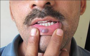 Гемангиома на лице: лечение, фото на губе и носу, причины и удаление