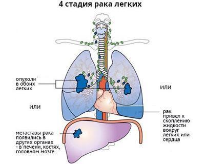 Центральный рак лёгкого: стадии, симптомы, прогноз, диагностика и лечение