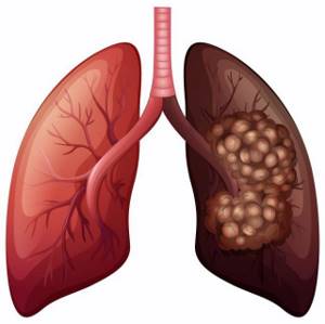 Метастазы в лёгких: прогноз срока жизни, симптомы и лечение