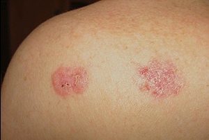 Рак кожи: фото начальной стадии, симптомы, лечение и диагностика