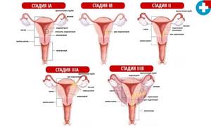 Аденокарцинома матки: прогноз, симптомы, стадии, операция и лечение