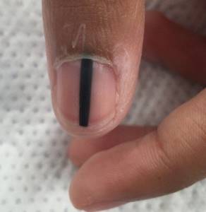 Меланома ногтя: фото начальной стадии, симптомы и лечение