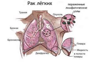 Температура при раке лёгких: причины, что делать и как помочь