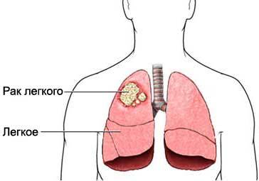 Опухоль лёгких: симптомы, виды, лечение, операция по удалению и стадии