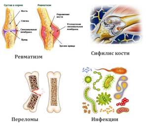 Остеобластома: симптомы и лечение на позвоночнике, челюсти, бедренной и других костях
