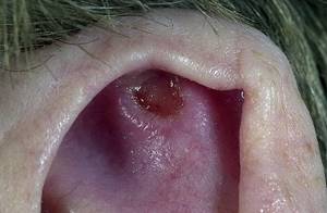 Рак уха: симптомы, фото и признаки на начальных стадиях