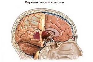 Рак мозга: причины, симптомы на ранних стадиях, лечение и диагностика