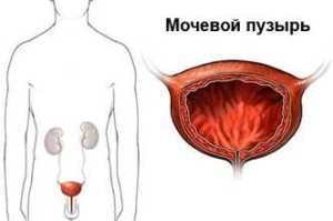 Рак мочевого пузыря: симптомы на ранних стадиях, лечение, стадии, причины и диагностика