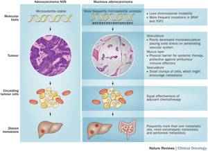 Аденокарцинома толстой кишки: формы, прогноз, симптомы и лечение