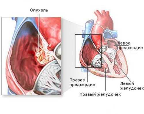 Рак сердца: симптомы, причины, стадии и продолжительность жизни
