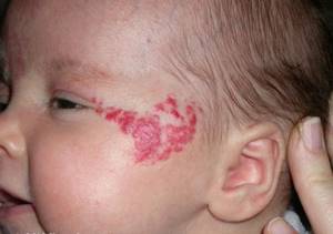 Гемангиома у новорождённых: причины возникновения, фото и лечение