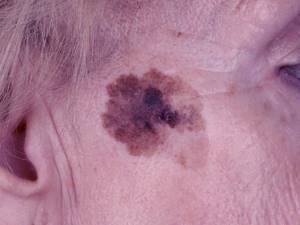 Лентиго-меланома: стадии, фото и прогноз