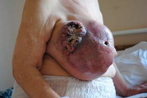Рак груди 4 стадии: сколько живут с метастазами, фото, симптомы и лечение