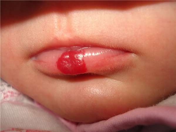 Гемангиома на лице: лечение, фото на губе и носу, причины и удаление