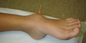 Жировик на ноге: фото, причины и быстрое лечение