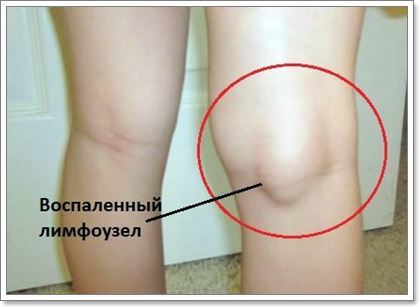 Лимфоузлы на ногах: расположение, фото, причины воспаления и лечение